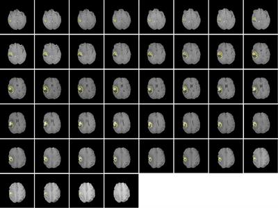 Morphometry-based radiomics for predicting therapeutic response in patients with gliomas following radiotherapy